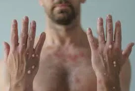 Monkey Pox Treatment in Pune: Everything You Need to Know at Lopmudra Hospital