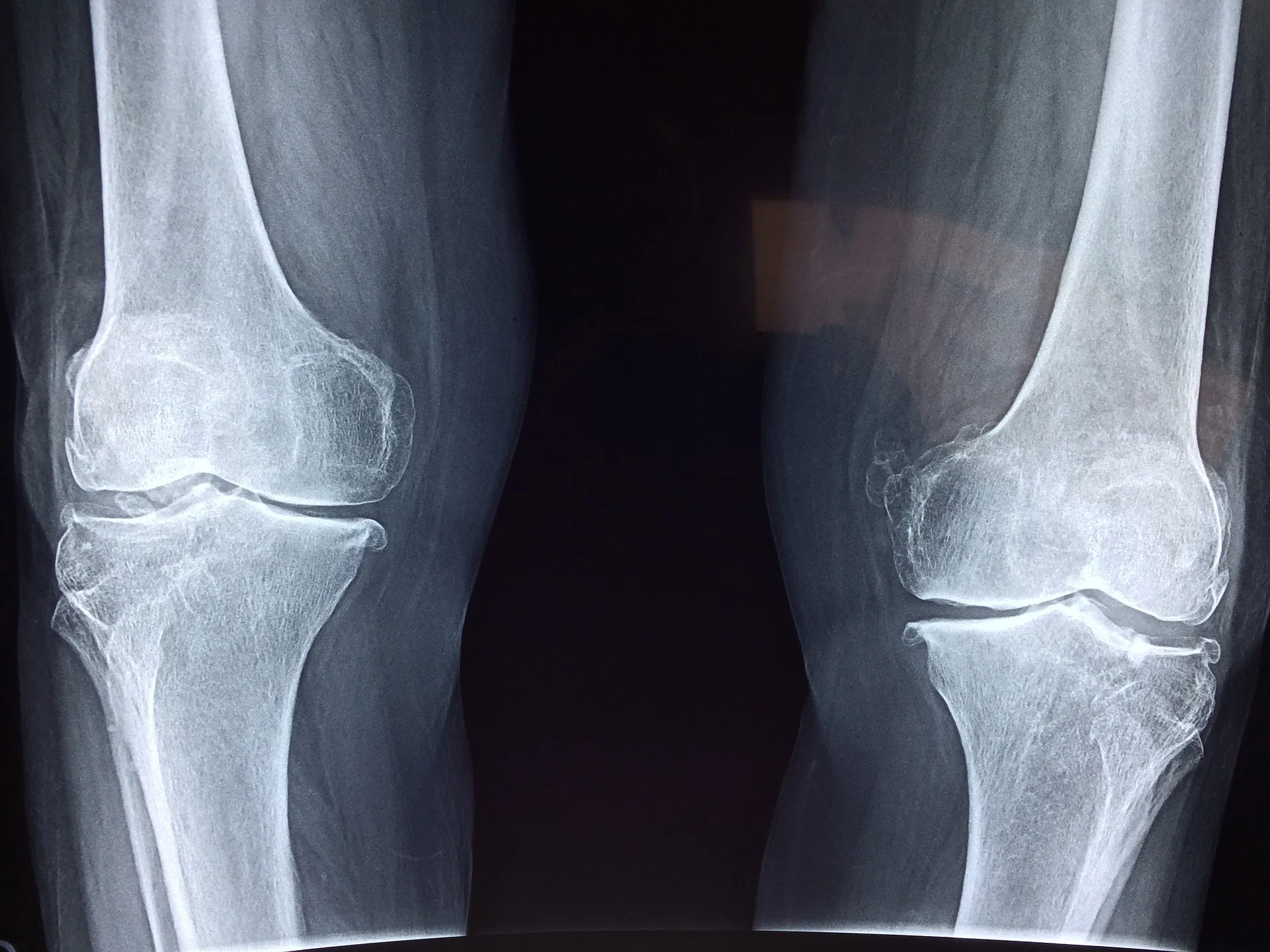 Understanding ACL Injury Symptoms: Essential Insights from Lopmudra Hospital Specialists