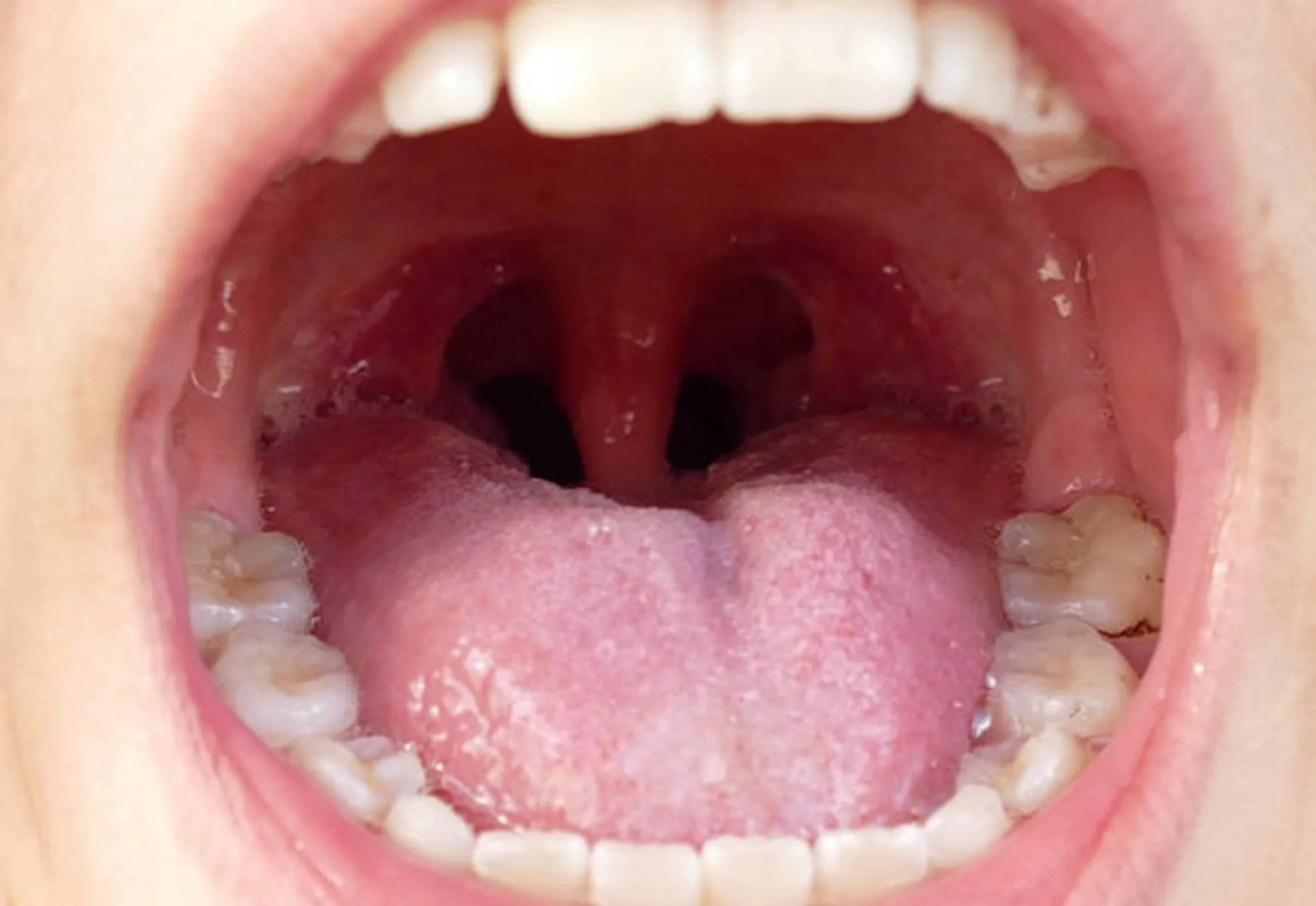 Effective Treatments for Tonsil Diseases in Pune at Lopmudra Hospital