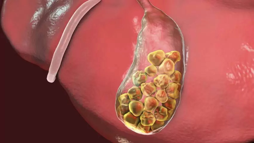 Understanding Gallbladder Stones: Causes Explained by Lopmudra Hospital Experts