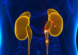 Understanding Kidney Stones: Symptoms, Diagnosis, and Treatment at Lopmudra Hospital