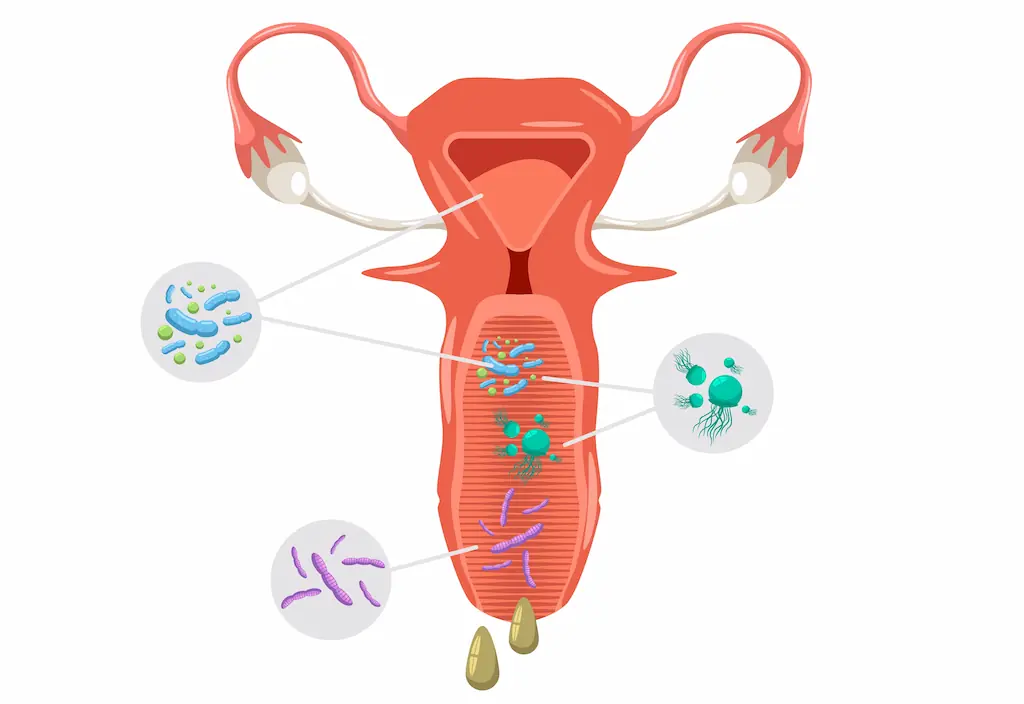 Bacterial Vaginosis: Causes, Symptoms & Treatment | Lopmudra Hospital Gynaecology & Obstetrics
