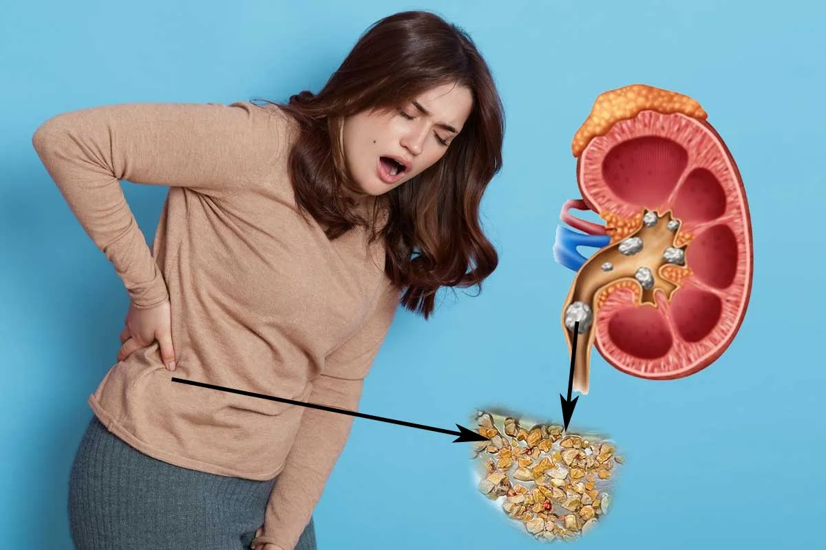 Immediate Relief from Kidney Stones Pain: Expert Tips from Lopmudra Hospital