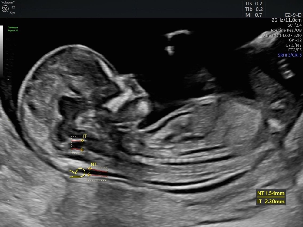 Understanding Anterior Placenta: Symptoms, Causes, Risks & Treatments | Lopmudra Hospital Gynaecology & Obstetrics