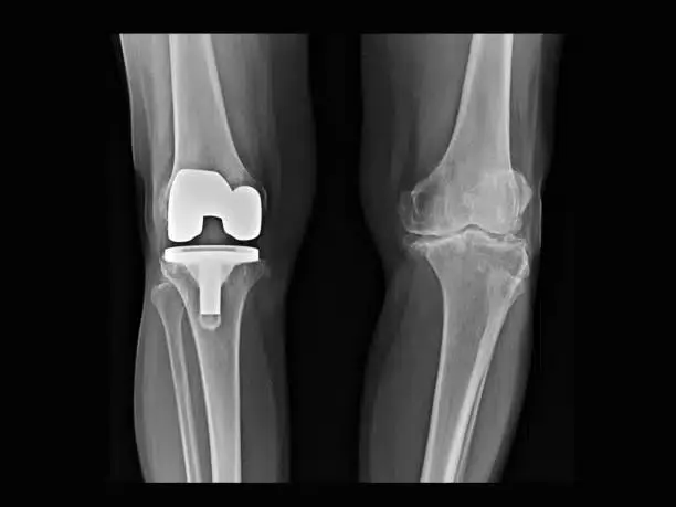 Knee Replacement Surgery in Pune – Expert Orthopaedic Care at Lopmudra Hospital