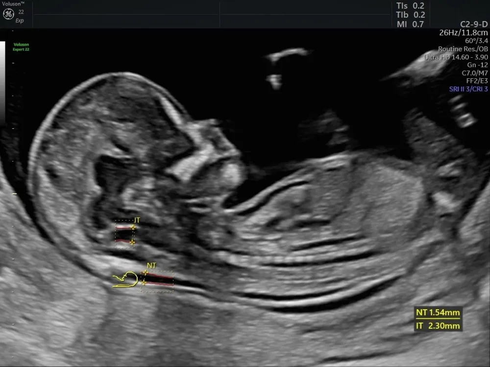 NT Scan Explained: Essential First Trimester Screening at Lopmudra Hospital Gynaecology & Obstetrics