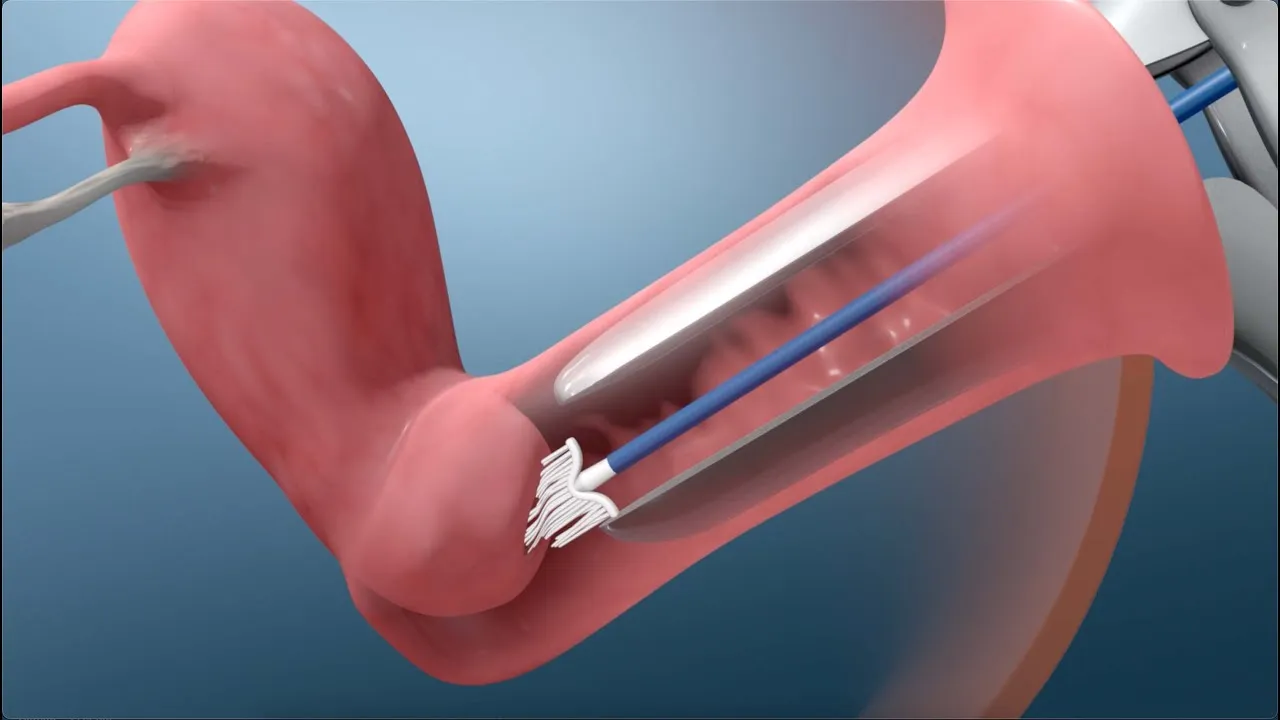Understanding Pap Smear Test: Essential Guide by Lopmudra Hospital’s Gynaecology & Obstetrics Experts