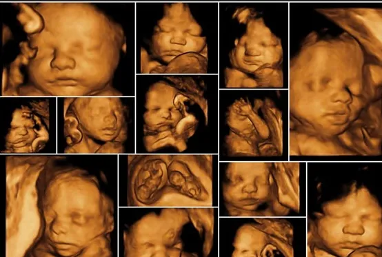 Preparing for an Anomaly Scan: Essential Tips from Lopmudra Hospital Gynaecology Experts