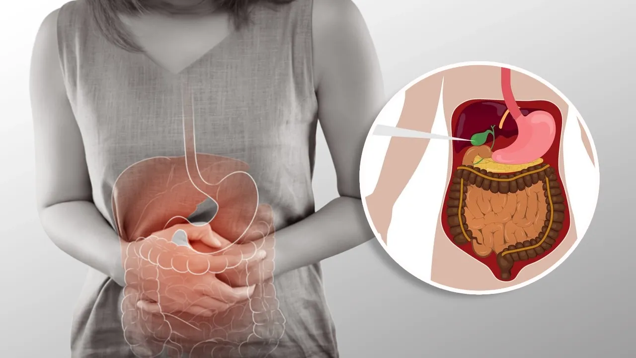 30mm Gallbladder Stone: Can It Be Removed Without Surgery? Lopmudra GI