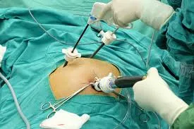Can Gallstones Be Removed by Laparoscopy? Lopmudra: Laparoscopic Cholecystectomy Explained