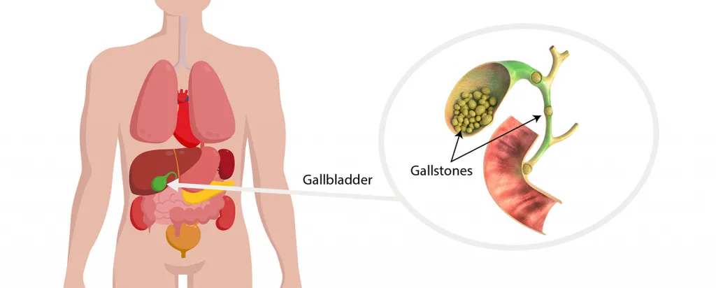 Gallstones: Symptoms, Causes & Treatment – Lopmudra Gastroenterology Guide