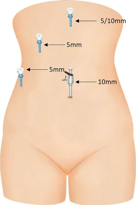 Gallstones in Women: Effective Treatment Options — Lopmudra, Hepatobiliary Specialist