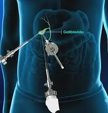 Gallstones Surgery: When Is Laparoscopic Cholecystectomy Needed? | Lopmudra (Laparoscopy)