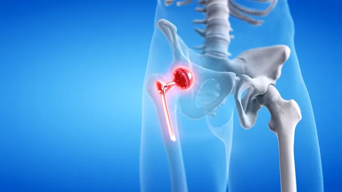 A Complete Guide to Joint Replacement Surgeries: Hip, Knee & Shoulder Solutions at Lopmudra Meera Hospital, Pune
