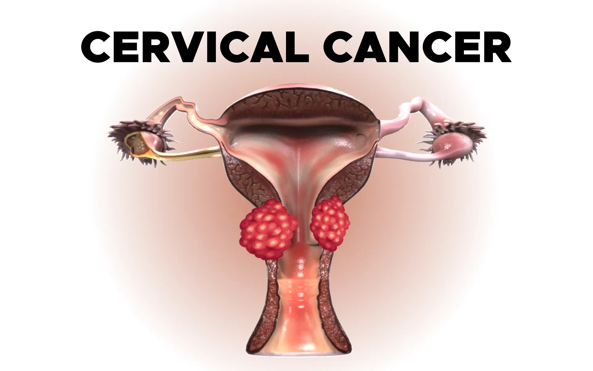 Cervical Cancer Awareness Camp in Pune: Screening, HPV Vaccination & Early Detection at Lopmudra Meera Hospital