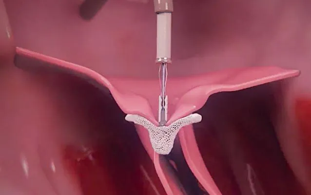 Heart Valve Repair and Replacement: What You Need to Know at Lopmudra Meera Hospital, Pune