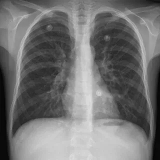 Accidental Pin Inhalation After a Sneeze: Fluoroscopy-Guided Bronchoscopy Removal at Lopmudra Meera Hospital, Pune